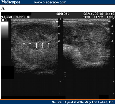 Primary Thyroid Lymphoma Associated With Graves' Disease - Page 2