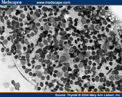 Primary Thyroid Lymphoma Associated With Graves' Disease - Page 2