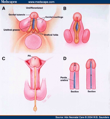 Hypospadias in the Neonate Page 4