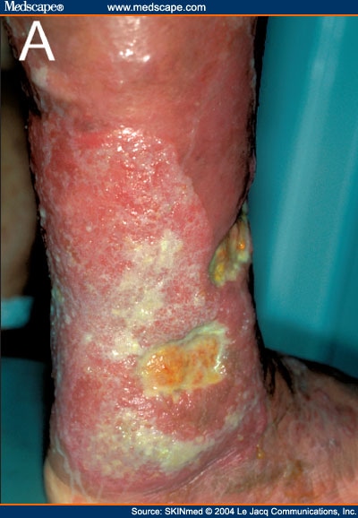 Klinefelters Syndrome Presenting With Skin Ulcers