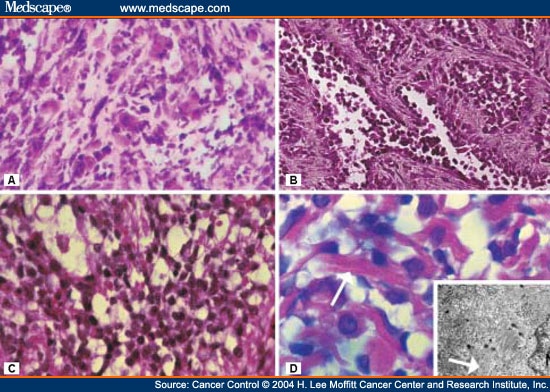 Orbital Rhabdomyosarcoma - Page 2