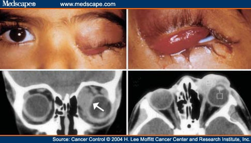 Orbital Rhabdomyosarcoma