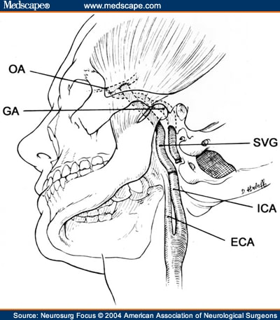 Aneurysms of the Petrous Internal Carotid Artery