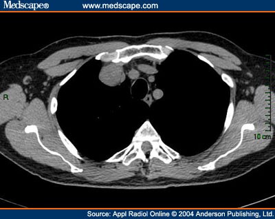 Incidental Mass