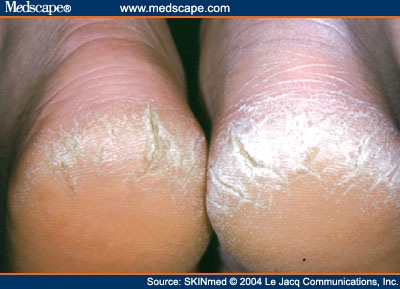 Hyperkeratosis Of The Heels Treatment With Salicylic Acid