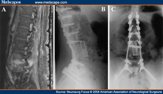 Surgical Strategies for Vertebral Osteomyelitis