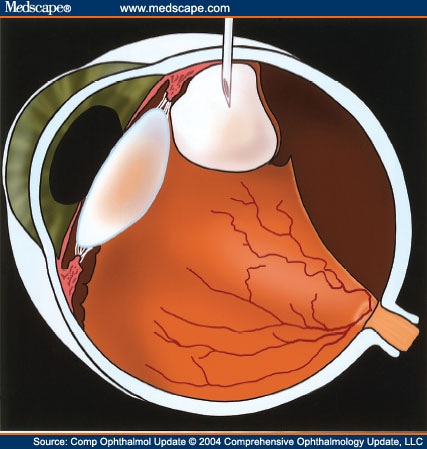 gas bubble detached retina