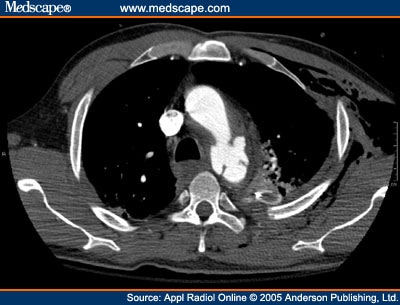 Abnormal Chest x-Ray After Motorcycle Accident