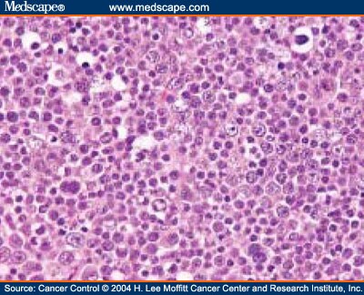 Pathology of Germ Cell Tumors of the Testis