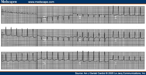 Ablation Therapy of Supraventricular Tachycardia in Elderly - Page 3