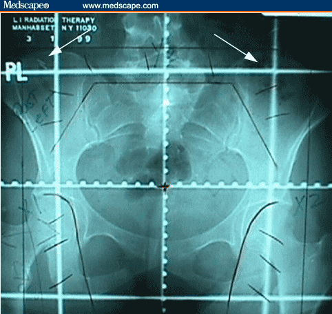 Laparoscopic Ovarian Transposition To Preserve Ovarian Function - Page 2