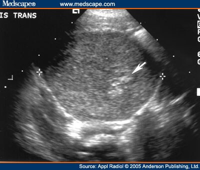 Radiological Case of the Month: Neuroblastoma