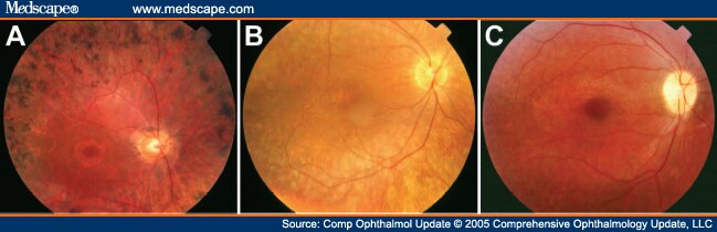 The Genetics Of Hereditary Retinopathies And Optic Neuropathies - Page 8