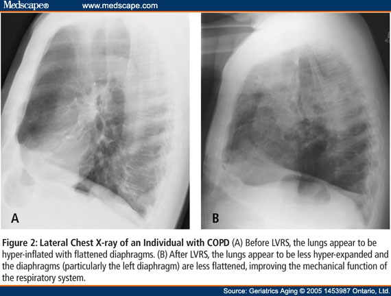 Surgical Interventions for COPD