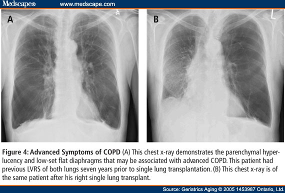 Chest X Ray Copd Vs Asthma My Xxx Hot Girl