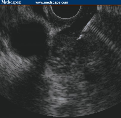 EUS-FNA in Diagnosis and Staging of Pancreatic Adenocarcinoma - Page 6