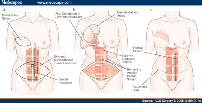 https://img.medscapestatic.com/fullsize/migrated/503/006/acs503006.fig11.jpg