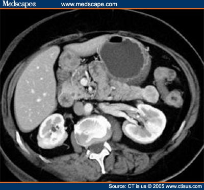 Adenocarcinoma or IPMN?