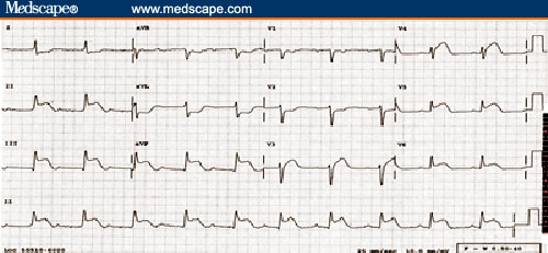 Infero-lateral Infarct or Inferior Infarct With RV Involvement? (I)