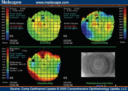 Corneal Topography and its Integration into Refractive Surgery