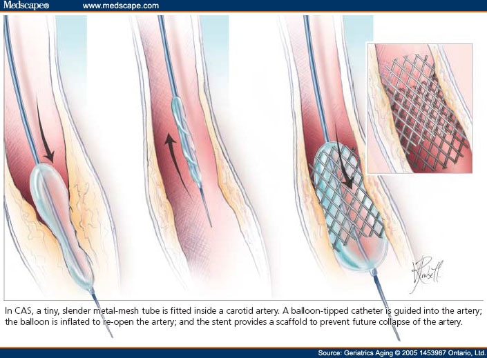 Internal Carotid Artery Stenosis In Older Adults