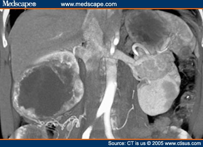 Bosniak II Cyst   Ctis507146.fig1a 