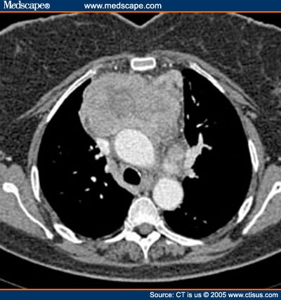 Is This Lymphoma?