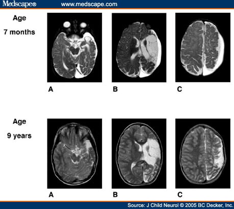 A 9-Year-Old Boy With a History of Large Perinatal Stroke - Page 2