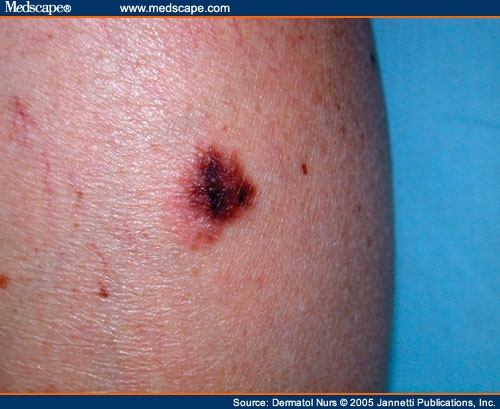 Assessing Malignant Melanoma: A Case Study