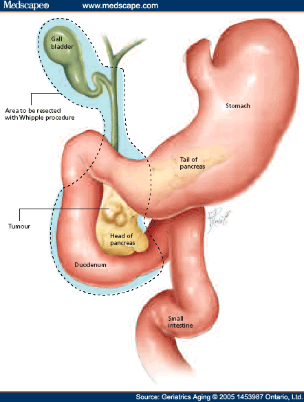 Pancreatic Cancer - A Review of Current Management Principles - Page 5