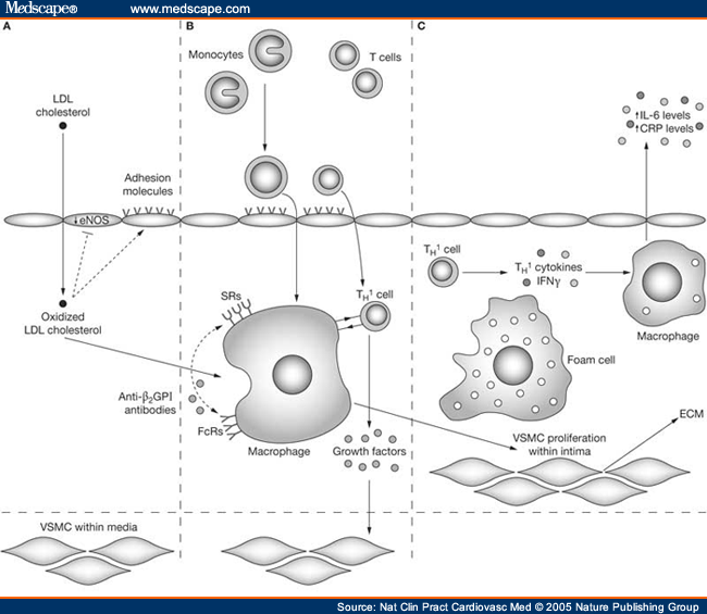 Cardiovascular Disease in Systemic Lupus Erythematosus - Page 4