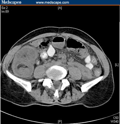 Ileocolonic Intussusception