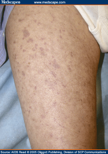 Vasculitis and Penumonitis in a Person With HIV Infection