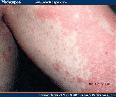 Pityriasis Rubra Pilaris