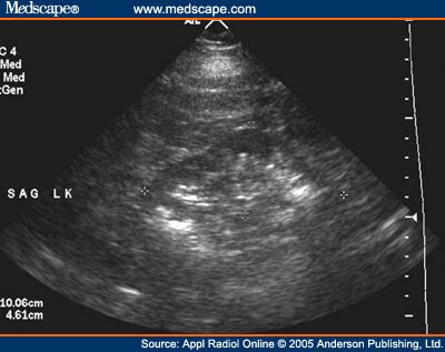 Right Flank Pain