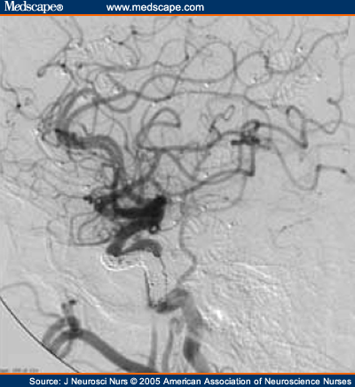 Carotid-Cavernous Sinus Fistula: A Case Study - Page 4