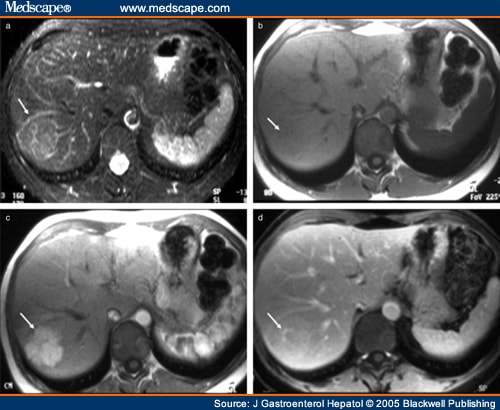 Persona herstel Sjah Focal Lesions in Normal Liver