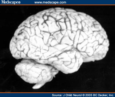 Neuropathology of Rett Syndrome - Page 3