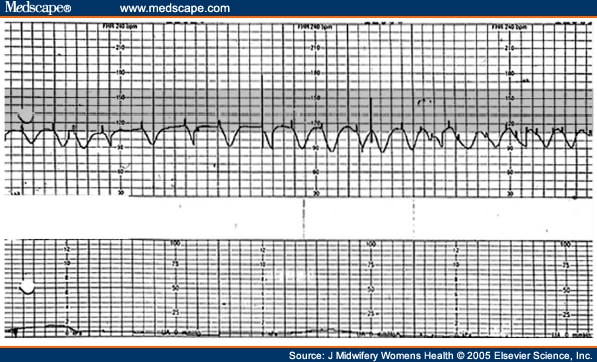 System Errors in Intrapartum Electronic Fetal Monitoring