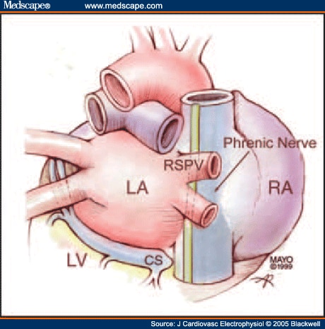 Phrenic Nerve Injury During Radiofrequency Ablation