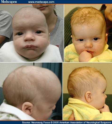 Endoscopic-Assisted Repair of Craniosynostosis