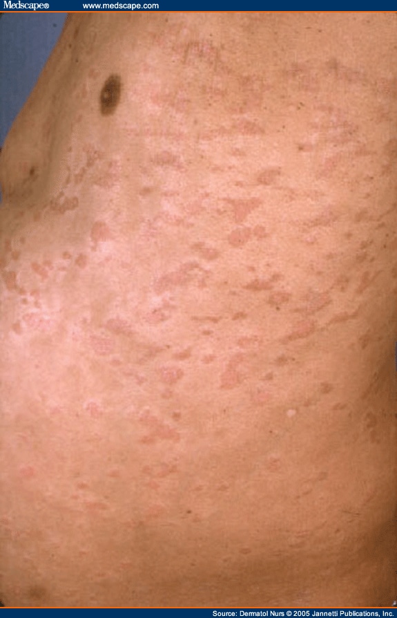 Pityriasis Rubra Pilaris: A Clinical Review - Page 3