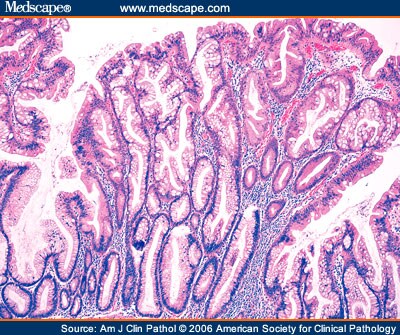 Sessile Serrated Adenoma Polypectomy Specimens: 8 Cases