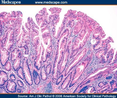 Sessile Serrated Adenoma Polypectomy Specimens: 8 Cases