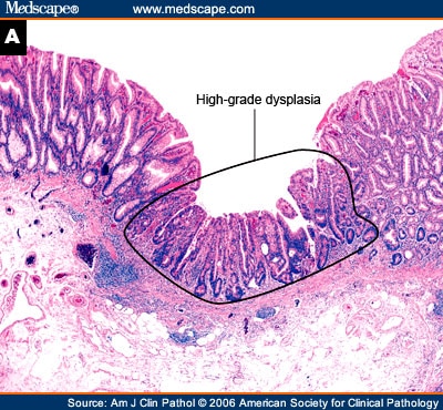 Sessile Serrated Adenoma Polypectomy Specimens: 8 Cases