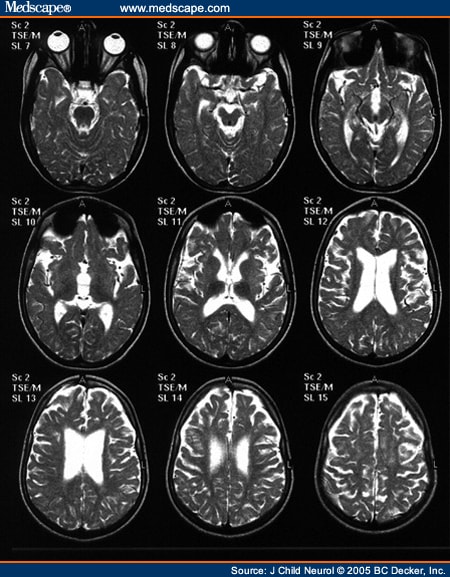 Case of Aicardi-Goutieres Syndrome - Page 2