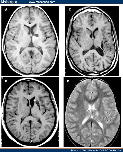 Aphasia Owing to Subcortical Brain Infarcts in Childhood - Page 3