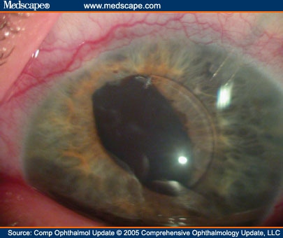 Cataract Surgery in the Glaucoma Patient - Page 5