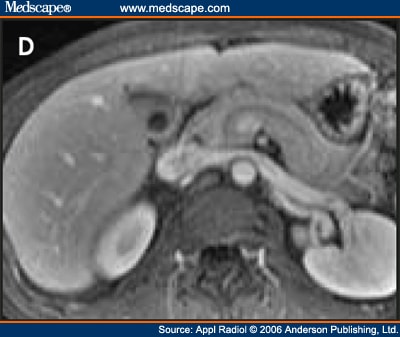 Magnetic Resonance Imaging of the Pancreas