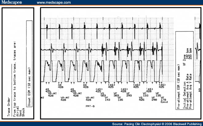 refractory atrial flutter icd 10